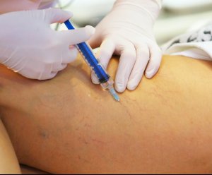 Vein Therapy Vein Therapy in Rockville Centre